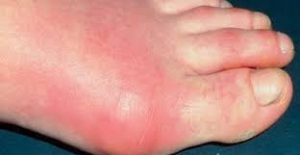 En el ataque de gota es muy típico la inflamación aguda del dedo gordo del pie